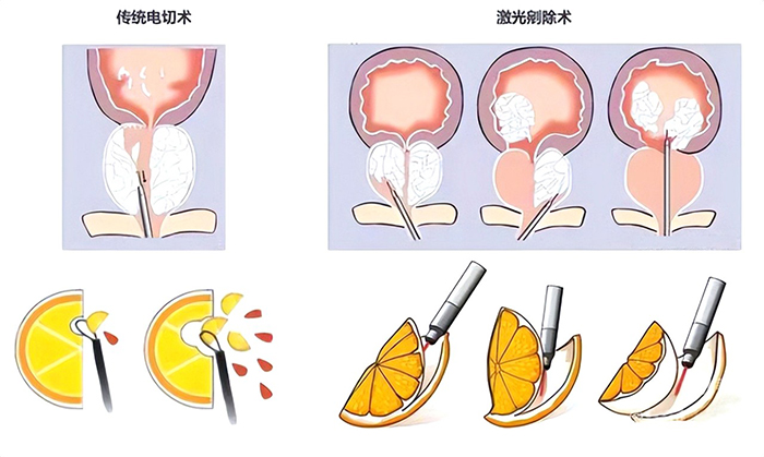 排尿困难8年 最后怎么样了