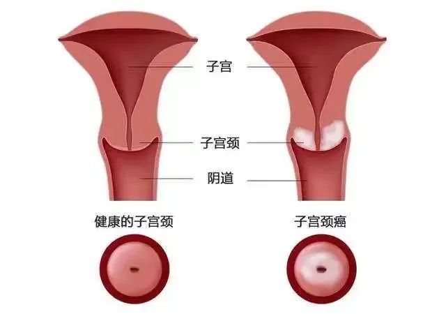 宫颈癌与男性有关?男女必知的常识!