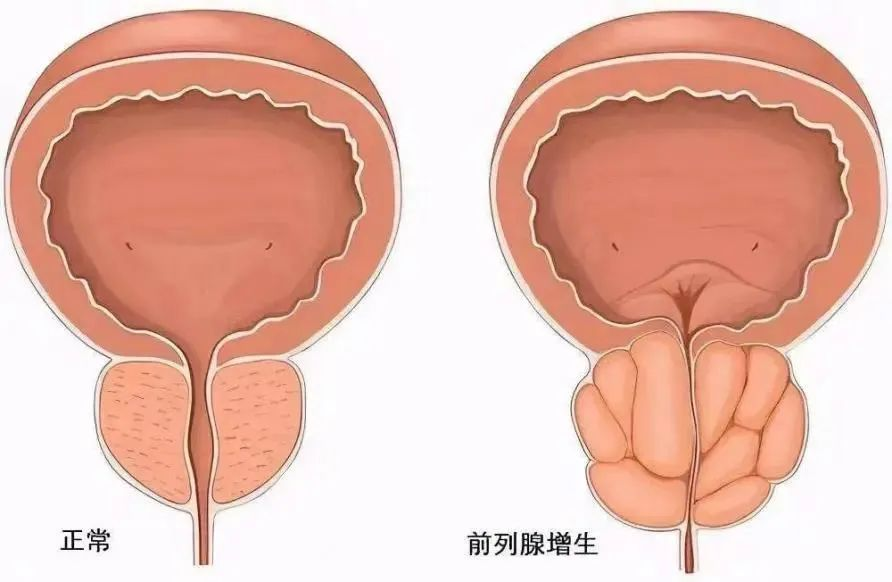 常见的泌尿系疾病有哪些？