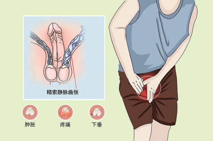 阴囊里的“小蚯蚓”——精索静脉曲张是怎么回事？
