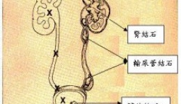 尿路结石是怎么形成的