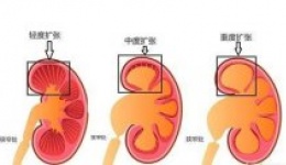 肾积水是什么